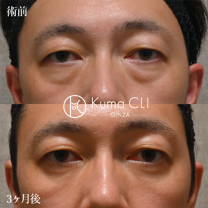 クマクリ 症例写真 裏ハムラ法evo＋ナノリッチ＋コンデンスリッチ 中顔面のボリューム改善